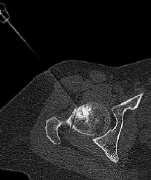 CT axial cut of the thermal ablation of the nidus in Case 8. The electrode end can be seen in the centre and the erroneous path of the trocar in the first attempt to approach it is displayed.