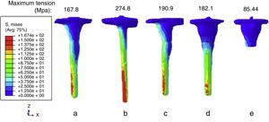 Distribution of Von Mises tension in the prosthesis 300 days after incorporating the prosthesis. (a) Offset. (b) Straight stem. (c) Offset with supplement. (d) Sleeves. (e) Sleeves without stem.