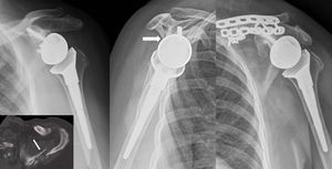Scapular spine fracture. Osteosynthesis with LC-DCP plates.