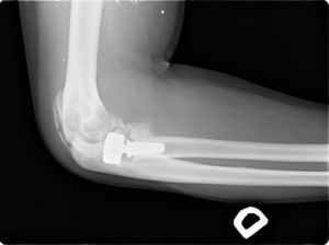 Example of heterotopic ossification. The joint surface was involved, with loss of flexion/extension and pronation/supination (Foruria Grade IIC) following type II fracture of the radial head and coronoid. Observe the calcifications in the anterior capsule and coronoid, as well as in the area of triceps insertion. Open arthrolysis was necessary.