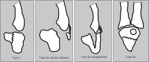 Classification of hamate fractures. Type 1: hamate hook fracture. Type 2a: coronal hamate body fracture (subdivided into oblique dorsal fracture and longitudinal fracture. Type 2b: transverse hamate body fracture. Based on Hirano and Inoue.10