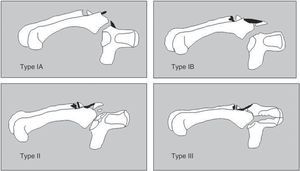 Classification of hamate body fractures when associated to carpometacarpal fracture-dislocation. Inclusion in this classification requires a fracture or dislocation of the base of the IV and V metacarpals. Type IA: subluxation of the base of the V metacarpal and tear of the dorsal carpometacarpal ligament. No radiographically apparent lesion of the hamate. Type IB: dorsal fracture of the hamate. Type II: dorsal comminuted fracture of the hamate. Type III: longitudinal coronal fracture of the hamate. Based on Cain et al.11.