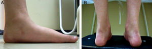 (A, B) Images obtained from one of the patients evaluated for flexible flat foot with the criteria described.