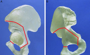 Paths of the osteotomies according to the Ganz technique. (A) Lateral view of the incision in the hemipelvis. (B) Medial view of the incision in the hemipelvis.