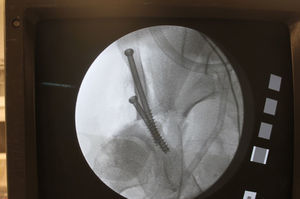 Intraoperative fluoroscopic control of the position of the acetabulum following its fixation.