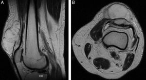 (A and B) MRI scan of the first patient, showing the pre- and suprapatellar tumour.