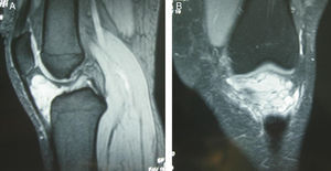 (A and B) MRI scan of the second patient, showing the infrapatellar tumour.