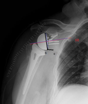 Prosthesis-scapular neck angle: formed by the intersection of a line extending from the uppermost point of the metaglene (a) to its lowest point (b) and another from the lowest point of the metaglene (b) to one medial centimetre to the same following the glenoid flange (c). The distance of the pin to the lower edge of the scapula: distance from the upper edge of the pin (d) to the lower edge of the glenoid flange (b). Tilt (outlined in red): angle formed by the intersection of a parallel line of the metaglene pin axis and another perpendicular to the glenoid neck (blue line). (For interpretation of the references to color in this figure legend, the reader is referred to the web version of this article.)