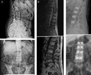 (A) First left: patient with multiple myeloma and several vertebral fractures. (B) Centre: magnetic resonance imaging scan confirming the acute origin of the fractures (oedema). (C) Third right: percutaneous bilateral kyphoplasty, with a satisfactory radiographic result, with no associated complications.