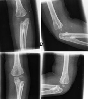 Radiographs of both elbows showing bilateral radioulnar synostosis.