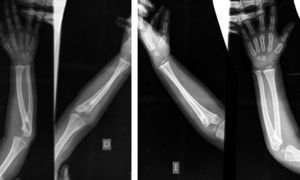 Radiographs of full forearms showing bilateral radioulnar synostosis.