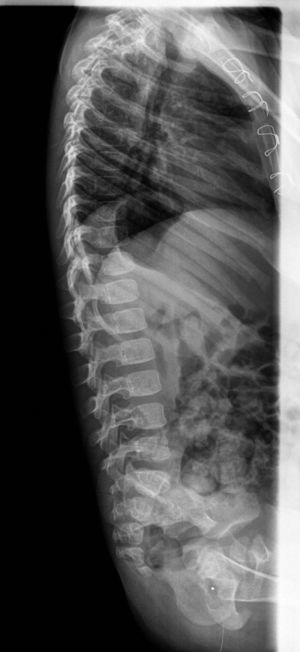 Radiograph of the spine with no significant alterations.