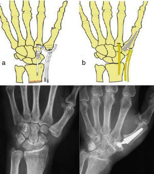 Diagrams and postoperative radiographs of the surgical techniques under study: (a) suspension-resection arthroplasty; (b) arthroplasty with prosthesis.