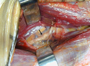 Release of the posterior interosseous nerve.