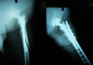 1cm subsidence detected by X-ray in an impaction grafting technique revision surgery patient. Immediately postoperative (image 5.1), the last check-up X-ray (image 5.2).