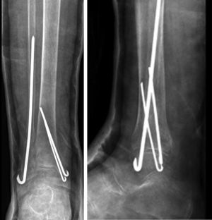 83 year-old patient. Bimalleolar fracture. Postoperative radiography after percutaneous treatment with Rush intramedullary nails.