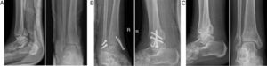 67 year-old patient. (A) Displaced trimalleolar fracture. (B) Postoperative radiography after treatment by open reduction and synthesis with interfragmentary screws and Kirschner wires. (C) Radiography at the end of follow-up with preservation of the reduction and radiographic signs of joint degeneration due to arthrosis.