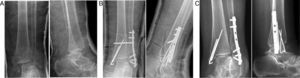 71 year-old patient. (A) Displaced bimalleolar fracture. (B) Postoperative radiography after treatment by open reduction and synthesis with screwed plate, Kirschner wires and supra-syndesmotic screw. (C) Radiography at the end of follow-up. Despite satisfactory initial reduction with joint congruence, the presence of degenerative signs in the form of subchondral sclerosis can be seen. The patient is asymptomatic.