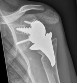 Anteroposterior left shoulder X-ray taken 24 months after revision surgery showing total reverse arthroplasty with a Verso® as the revision implant revision.