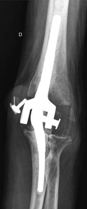 Wear of the polyethylene with breakage of the pins 5 years after the fracture with an implant that has no signs of loosening.