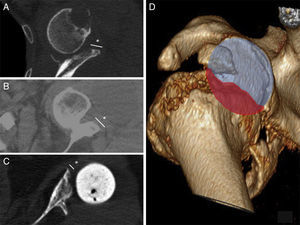 (A–C) Preoperative axial CT scans showing the bone remnant (*) and thereby also revealing the existence of the underlying defect. (D) Calculation of the glenoid defect in a 3D reconstruction, estimated in this case at approximately 30%.