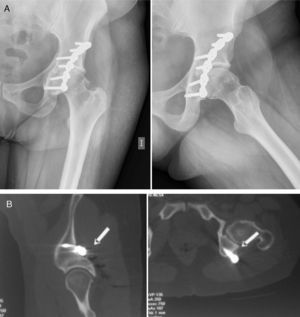 (A) Simple anteroposterior and axial hip X-ray showing degenerative signs, with no loosening of the osteosynthesis material. (B) CAT showing the zone where the screw protrudes (arrowed) close to the sciatic nerve.