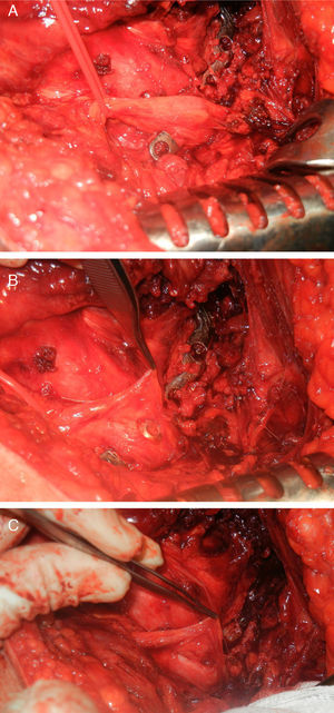 Intraoperative images. (A) Identification of the sciatic nerve over the osteosynthesis plate, showing thickening of the nerve in the zone. (B) Initial dissection showing the protrusion of one of the osteosynthesis screws. (C) The final situation following removal of the plate in which the presence of a buttonhole in the cross-section of the sciatic nerve stands out.