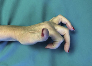 “Extrinsic finger” situation in the fourth and fifth fingers.