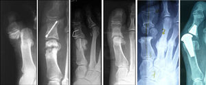 Preoperative X-rays of different types of hallux valgus surgery sequellae leading to severe shortening of the first ray.