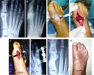 (A) Infectious arthritis after a chevron osteotomy. (B) Resection of the necrotic metatarsal head bone and implantation of polymethyl methacrylate (PMMA) as a temporary spacer. (C) Extraction of the cement. (D) Preparation of a zone for the graft. (E) Elongation with an external minifixator. Implantation of the structural bone graft. (F) X-ray of the minifixator and bone graft at 3 months. (G) Radiography at 6 months. (H) Clinical result at one year.