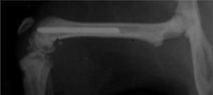 X-ray of a femur with a Ti6Al4V needle implanted inside it.