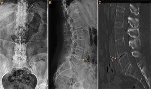 (A) Anteroposterior lumbosacral X-ray while standing. (B) The same, with a lateral projection. The arrow points to the visibly reduced L4–L5 space and the degenerative alterations such as the anterior osteophyte. (C) Image showing the presence of air in the L4–L5 space that makes manifest the disc degeneration in the said space and its reduction in height.