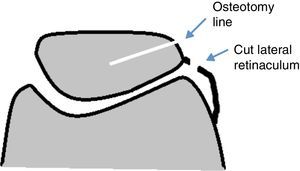 Diagram of the operation performed (coronal osteotomy of the patella and section of the lateral retinaculum of the patella).