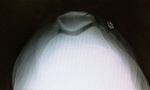 Postoperative axial X-ray showing the osteotomy performed.