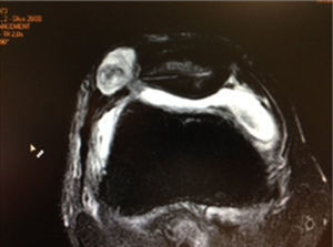 MRI of the case in which a synovial liquid fistula appeared due to accidental arthrotomy when cutting the lateral retinaculum.