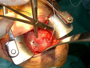 Intraoperative image. Placement of the restore (De Puy Mitek®) (porcine intestinal submucosa mesh).