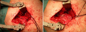 Intraoperative images. After repairing the cuff with Healix-type anchors, the Restore (De Puy Mitek®) porcine intestinal submucosa mesh was implanted as reinforcement.