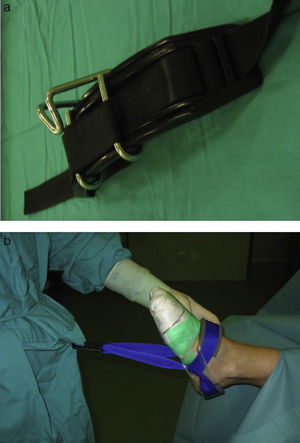 The harness is placed by the surgeon around his waist under the gown (a). Then the surgeon puts on the gown and anchors the sterile Guhl strap to the harness (b). This enables us to apply traction to the ankle joint on demand.