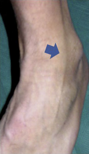 We identify the intermediate dorsal cutaneous branch of the superficial peroneal nerve using the fourth toe flexion sign.