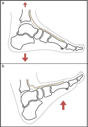 The application of traction on the joint enables almost complete visualisation of the articular cartilage of the talar bone (a). By contrast, with the ankle dorsiflexed the articular cartilage is concealed, protecting it while the material is inserted, and the anterior neurovascular structures are relaxed, enabling them to be moved away during the introduction of the material, reducing the risk of injury to them (b).
