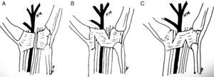 (A) Complete resection of the LCT. (B) Elongation of the TCL according to Simonetta's technique.13 (C) Elongation according to the technique presented in this work.