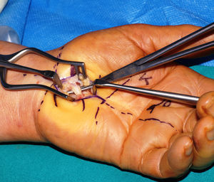 Intraoperative image showing elongation of the LCT.