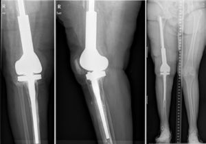 Anteroposterior and lateral X-ray after the second operation. A cemented modular tumoral prosthesis was used, to resolve the bone defects and achieve proper stability.