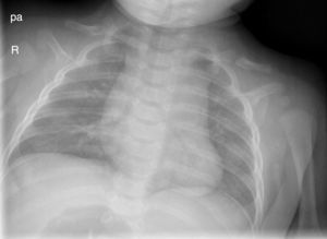 1 X-ray of the patient 4 months old where the pseudarthrosis of both clavicles is confirmed.