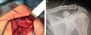 Case number 9. (A) Intraoperative image showing the anatomical reduction of the fracture (blue arrow) and the disposition of the implant in the proximal clavicle (D-CLA: distal clavicle; P-CLA: proximal clavicle; Co: coracoid). (B) Postoperative check shown in the anteroposterior projection of the shoulder.