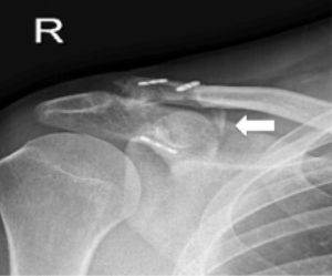 Case number 3. Anteroposterior X-ray of the clavicle showing ossification of the coracoclavicular ligament route at 6 months after surgery (white arrow). R, right.