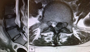 (a) Sagittal slice MRI: extruded disc herniation L4–L5 with caudal migration. (b) Axial slice MRI: left paracentral disc herniation touching the nerve root and retracting the dural sac.