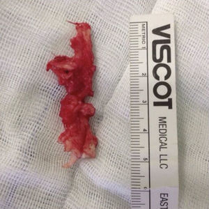 Hernial fragment of lumber intervertebral disc obtained after discectomy.