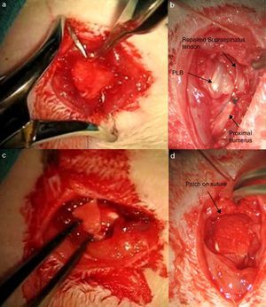 Tendon repair: (a) completion of transosseous tunnel; (b) transosseous suture; (c) rhBMP-2-loaded patch; (d) rhBMP-2-loaded hybrid suture.