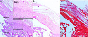 Repair with carrier and rhBMP-2: (a) haematoxylin–eosin stain. Area of normal transition, presence of collagen particles with uniform (++) direction; (b and c) haematoxylin–eosin and Syrian rue stains. Parallel-aligned collagen matrix (+).